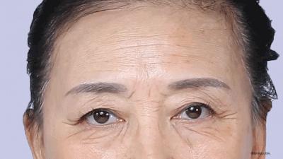 抬头纹法令纹鱼尾纹克星能管用吗,抬头纹鱼尾纹法令纹均可改善