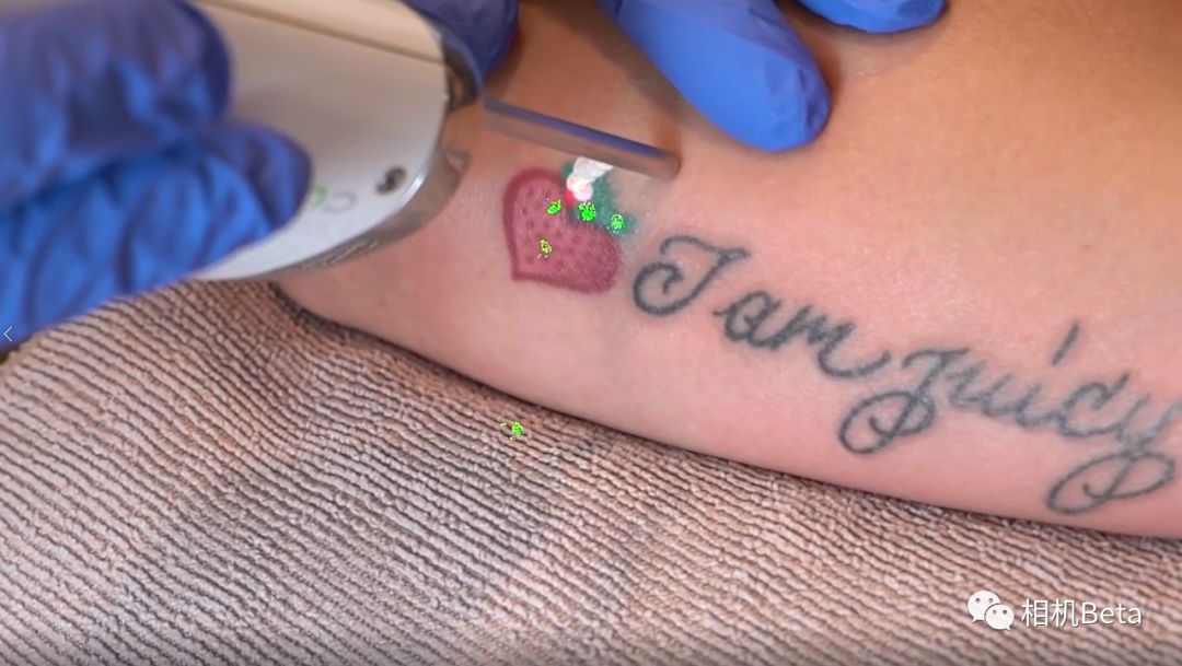 激光洗纹身真的不会留疤吗,索尼a7s2斑马纹