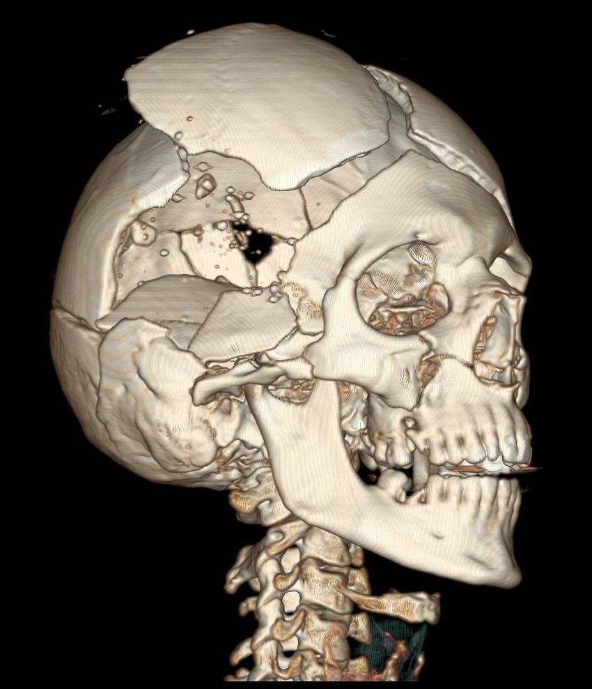 人体中弹会怎么样,人体中枪后果