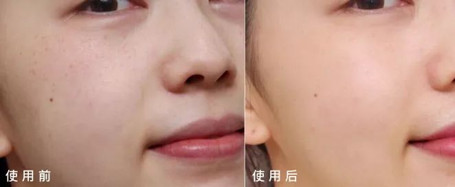 严重痘印晒斑,5个祛斑小妙招淡化晒斑雀斑痘印