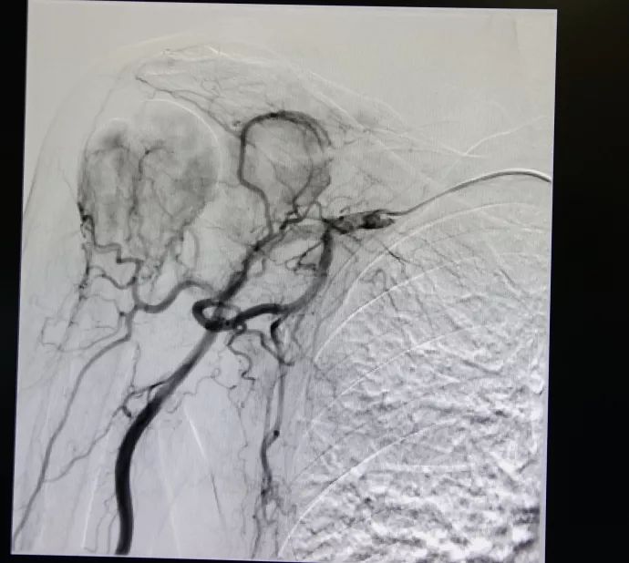 四肢疼痛难忍介入治疗即刻缓解