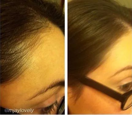 养发防脱拯救发际线洗发水,生发发际线的神器测评