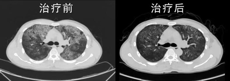 肺部洗出17升牛奶,毛骨悚然男子肺部竟洗出17升牛奶