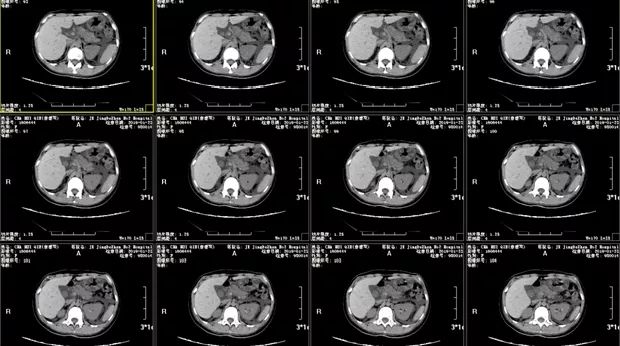 又遇疑难腹水案,且看元芳如何破!