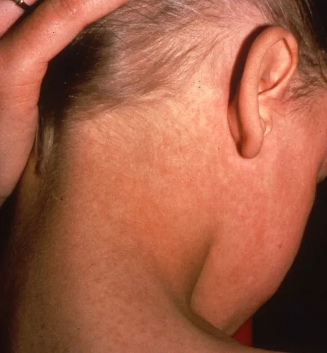 宝宝高烧后身上起疹子是怎么回事,宝宝高烧不退脸上有红点