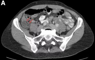 结肠镜检查疼吗,做完电子结肠镜后有腹痛