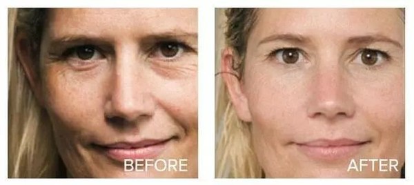 深扒美白成分不可不知的烟酰胺,高端美白针