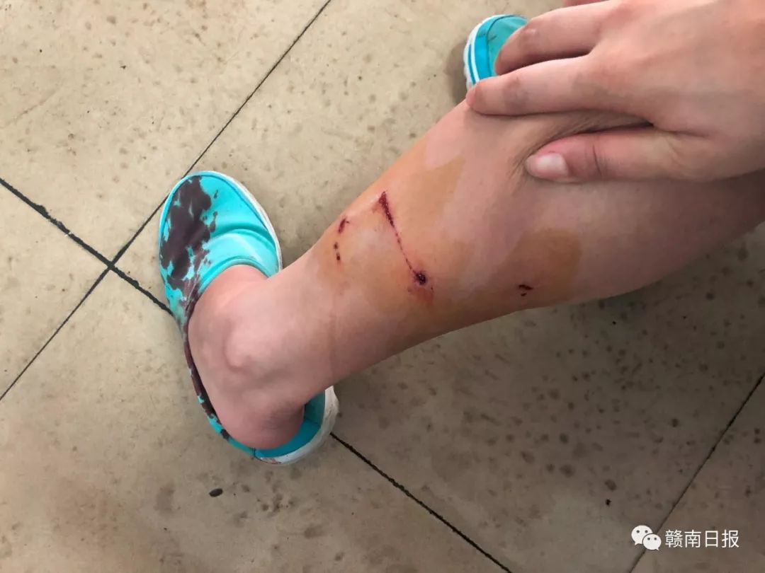 可怕疯狗咬伤多人警方紧急出动,疯狗咬伤6人