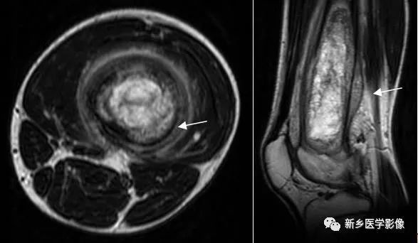 骨骼疾病怎么调理最有效,骨骼坏死最佳治疗方法