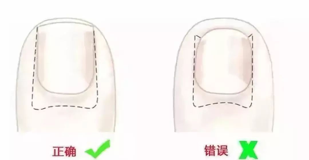 趾甲扎进肉里了，一碰就痛？用它一贴，1分钟止痛，趾甲往外长，再也不扎痛了！