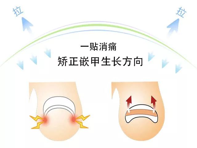 小脚趾甲长在肉里一碰就疼怎么办,指甲扎到肉里怎么处理