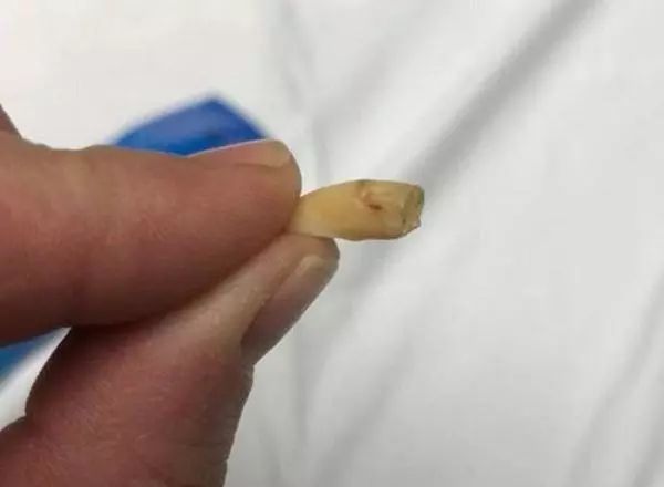 【新焦点】惊！事发平罗！威化饼干中吃出一颗牙齿！河北厂商道歉并赔偿2000元