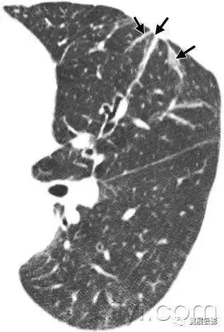 胸部解剖及常见疾病影像表现,胸部影像学基础知识