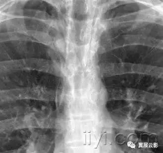 胸部解剖及常见疾病影像表现,胸部影像学基础知识