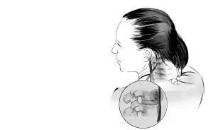 千万别乱挤痘痘一不小心就进了icu,挤掉痘痘后留了个洞