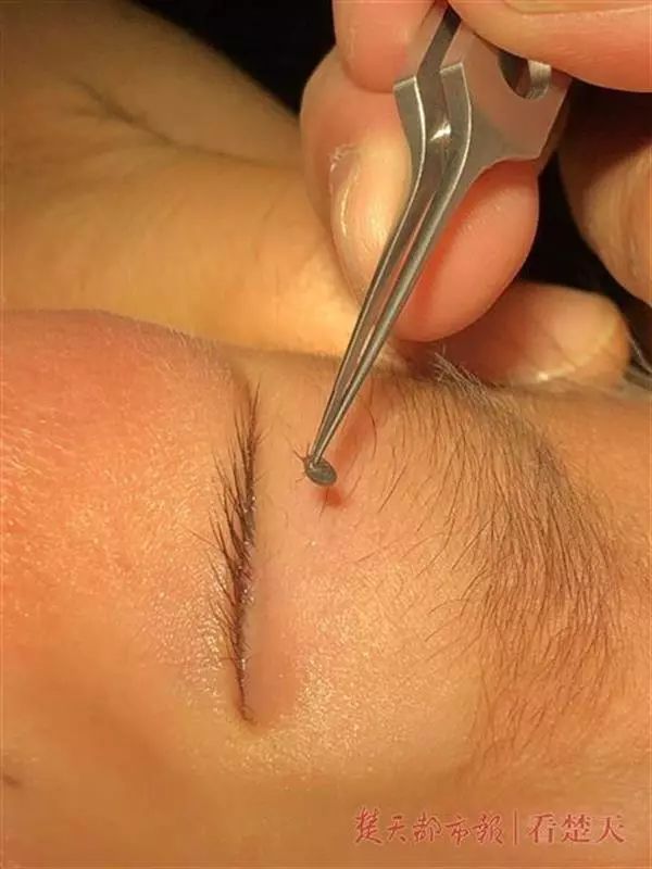 2岁男孩眼皮上突然冒出一个小黑点！医生：这东西会要命！眼下高发，别大意！