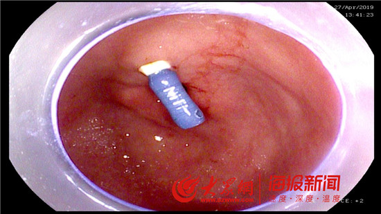 胃内“根管锉”险象环生淄博昌国医院妙手化险为夷