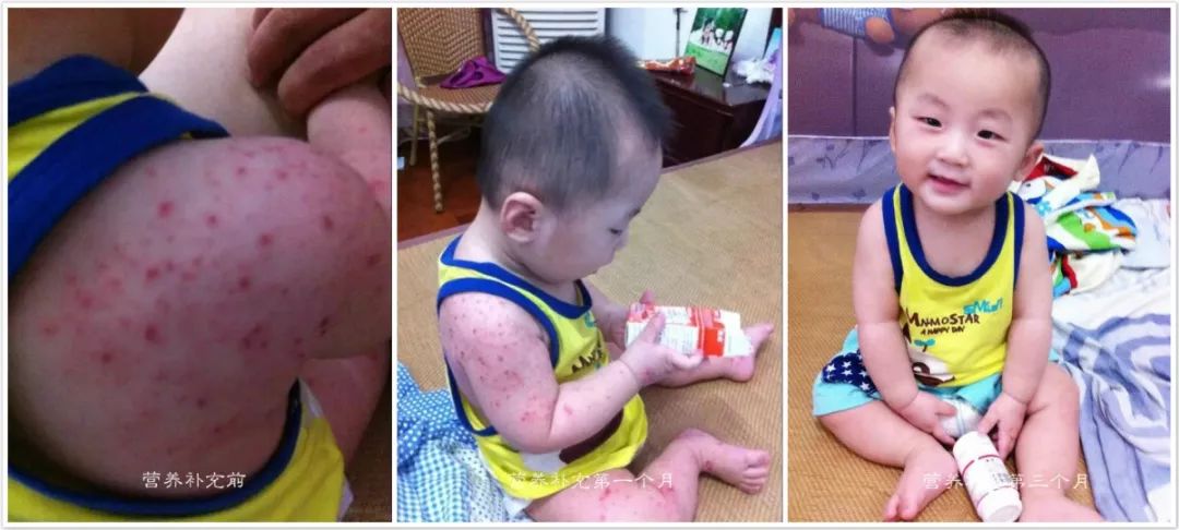 湿疹护理用什么护肤霜,湿疹护理的小结