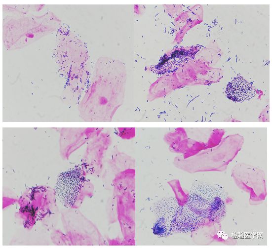 6岁小女孩竟然得了阴道炎？每位妈妈都应该注意！