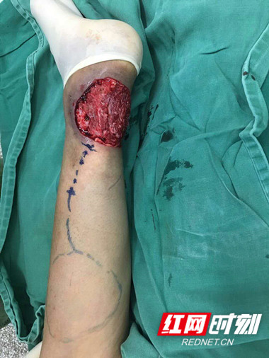 脚后跟坏死做皮瓣多久能好,脚部烂肉愈合需要做植皮手术吗