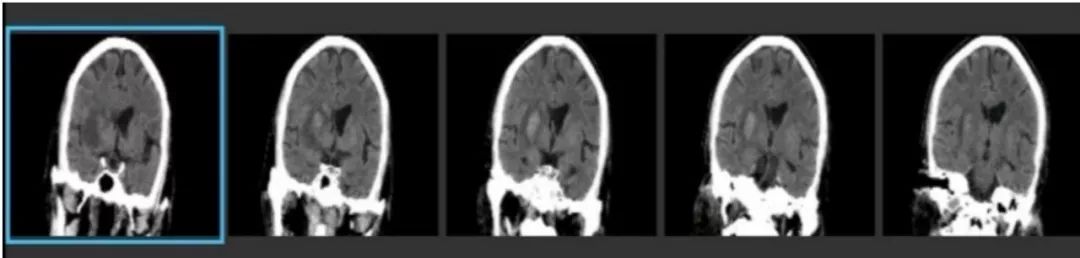 径技·例量|25期：再灌注出血—防不胜防