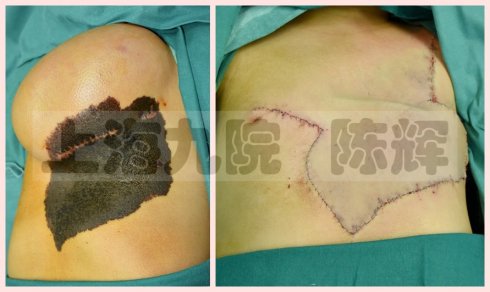 点黑痣后用什么修复最好,黑色素痣扩张术是什么原理