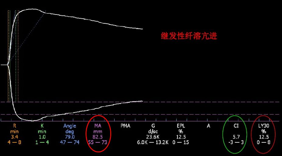 硬核区分原发性纤溶亢进与继发性纤溶亢进