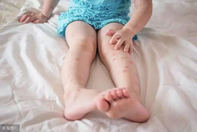 泰国蚊子咬止痒膏,防蚊虫叮咬药膏推荐泰国