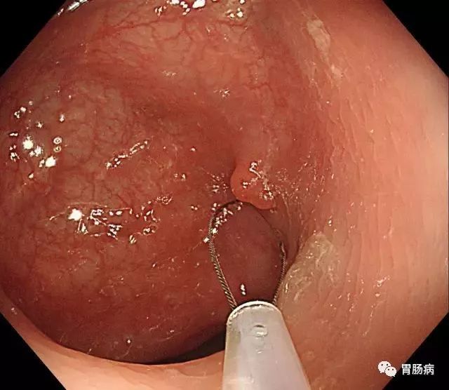 结肠息肉切除术术前准备,结肠镜下息肉冷切除术