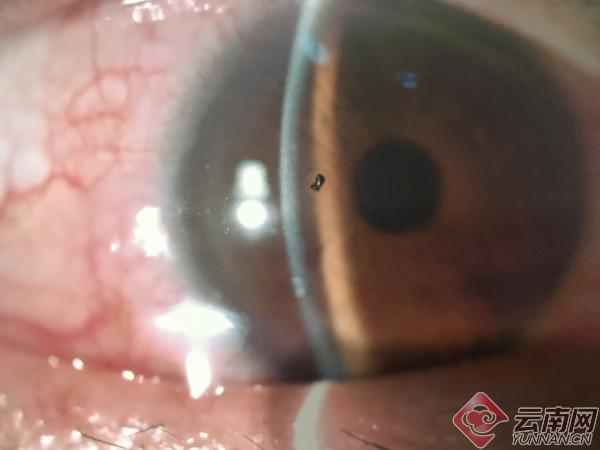 异物进入眼睛应及时处理否则当心视力严重受损