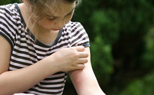 使用！总被蚊子咬？涂点这个马上止痒