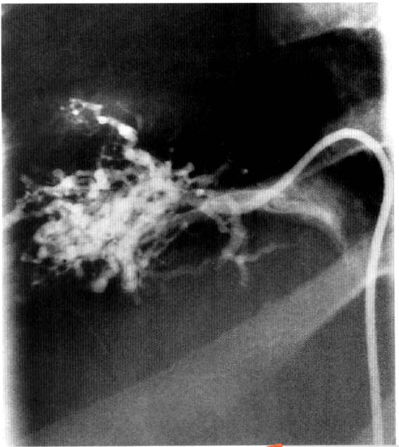 布加综合征症状目前有治疗方法吗,布加综合征前期的症状
