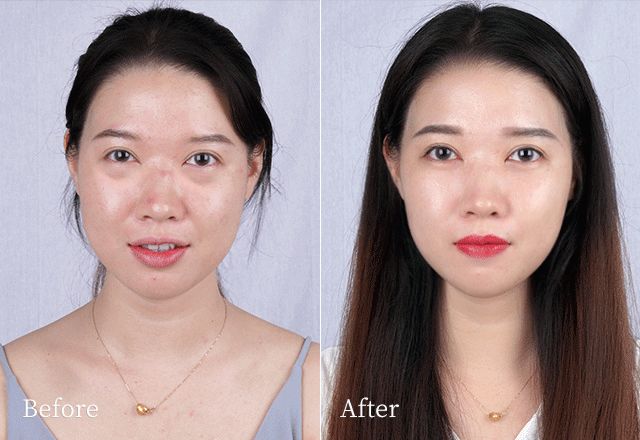 眼袋松弛下垂最快解决方法,严重眼袋下垂松弛怎么恢复