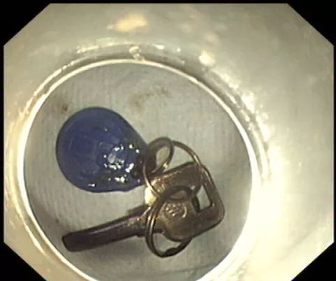 男子酒醒后胸口很痛，去医院检查一看，惊呆了？