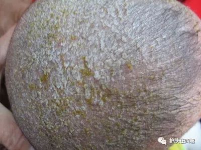 头皮脂溢性皮炎怎么彻底根除,毛囊炎和脂溢性皮炎的区别图
