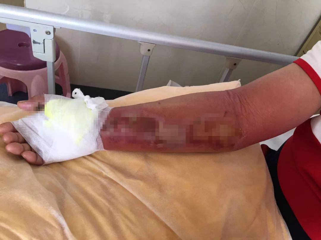 被虾刺破手了会导致什么病,被大虾刺破手指有危险吗