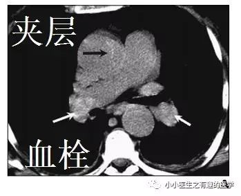 ct平扫肺部能查出是哮喘吗,ct平扫肺结节准确吗