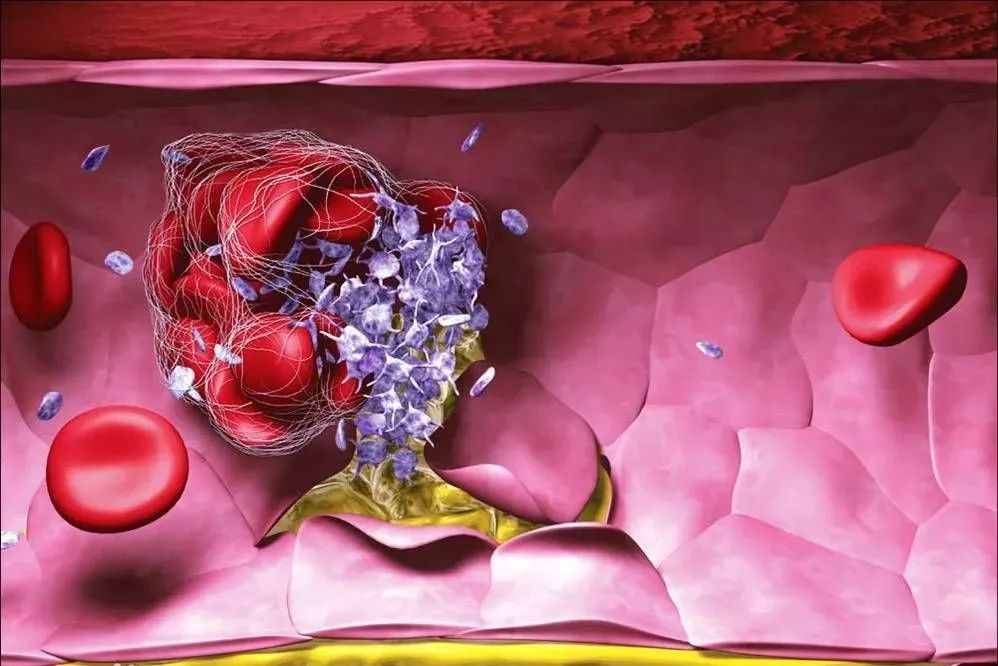 硬核区分原发性纤溶亢进与继发性纤溶亢进