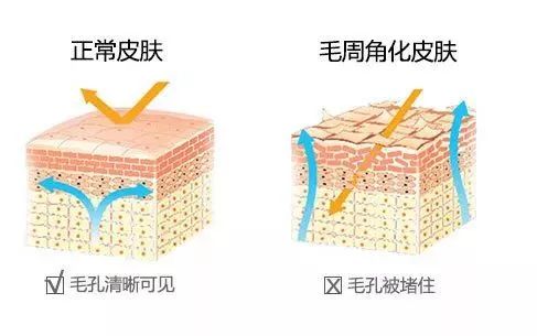 鸡皮肤永久消除,37天快速祛鸡皮肤