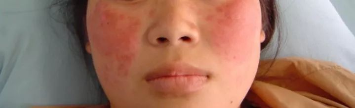 系统性红斑狼疮是不死的癌症,红斑狼疮为啥是不死的癌症