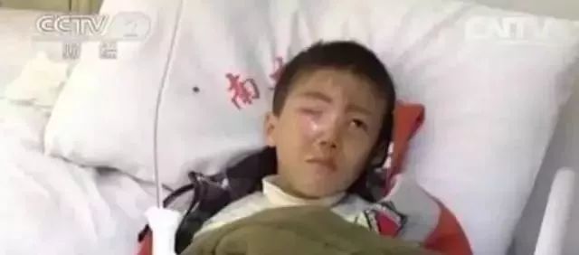 7岁男孩眼球被炸后融化,男童眼球瞬间被融化
