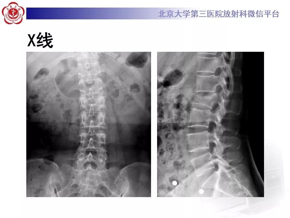 「每日一例｜893例」女，49岁，摔伤致腰部疼痛，活动受限1天