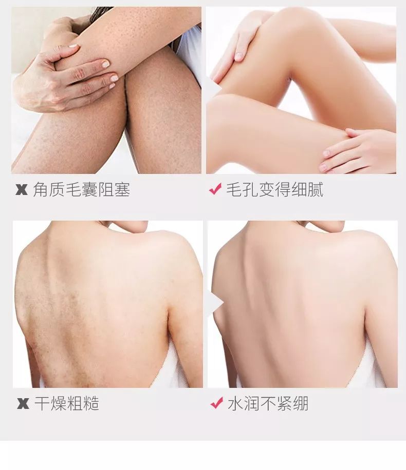 20分钟清理背部螨虫痘痘,十秒去除螨虫