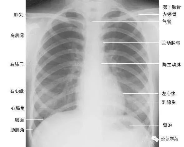 胸部ct解剖结构,胸部x线解读视频