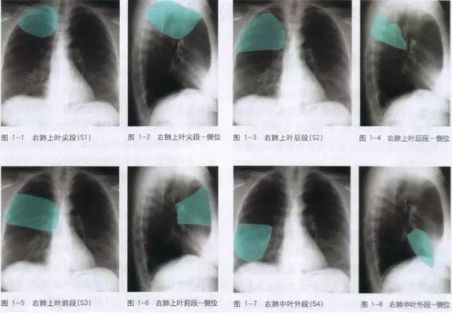 胸部ct解剖结构,胸部x线解读视频