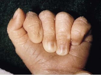 指甲很脆是因为缺少什么营养素,婴儿指甲特别脆是缺乏营养么