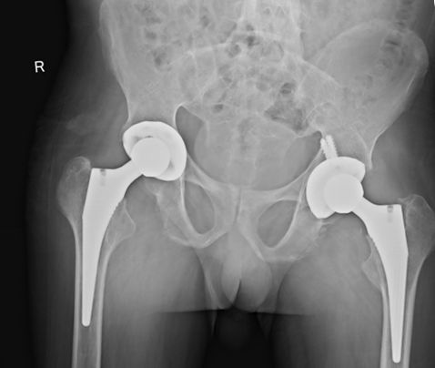 骨道堂治疗强直性脊柱炎效果,御医堂治疗强直性脊柱炎