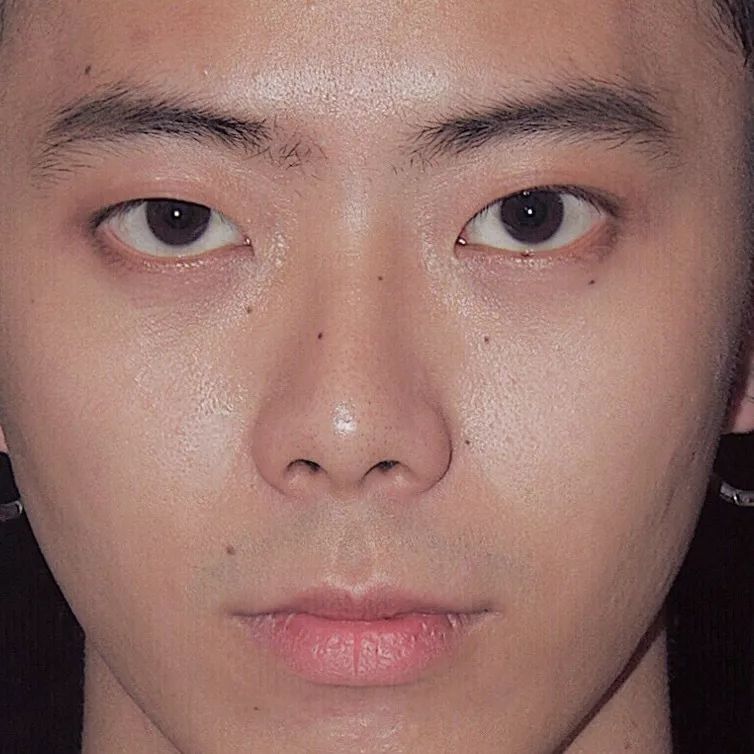 脸上有痣是不是代表有福,脸上长痣的前提是什么