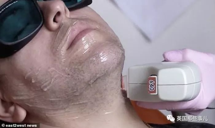 产后长络腮胡,女子生完孩子后长出满脸络腮胡