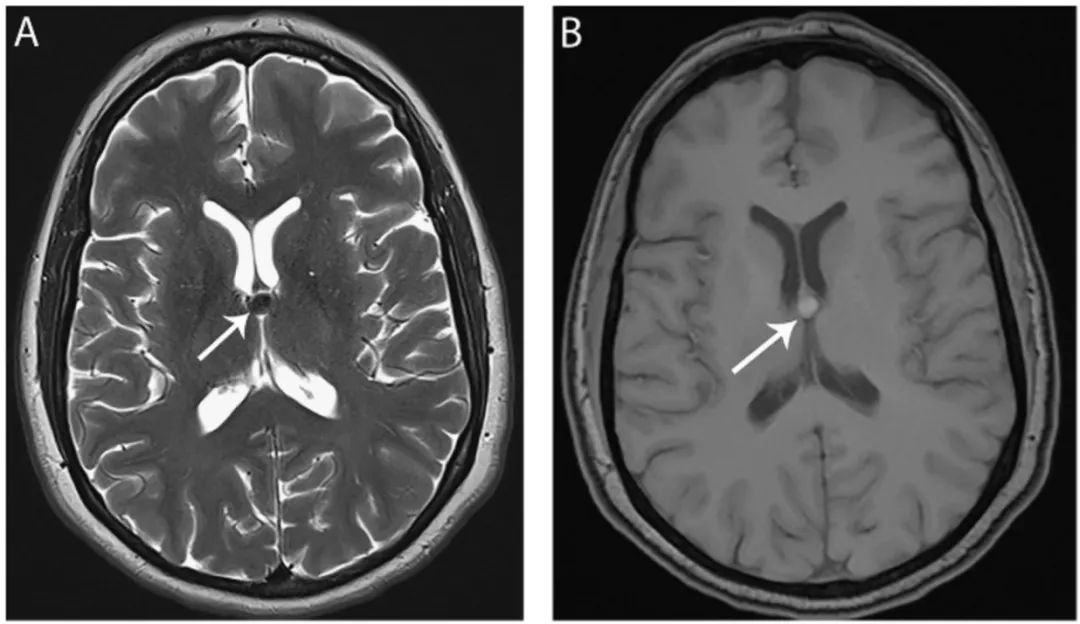 多图多表：带你识别颅内囊肿的影像学表现丨实战读片